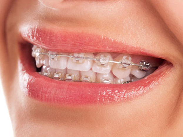 Are Lingual Braces More Uncomfortable than Traditional? – Cool