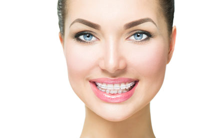 The Benefits of Clear Braces in Sterling and Invisalign - Titan